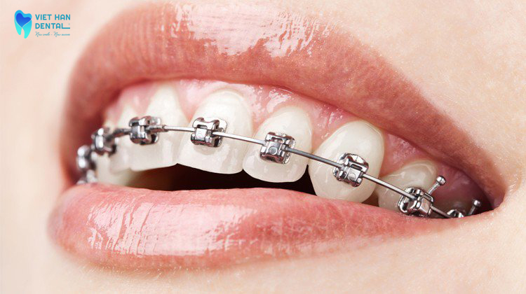 Niềng răng mắc cài kim loại phổ biến nhất hiện nay tại nha trang