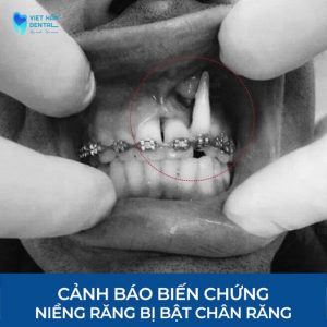 cac-bien-chung-nieng-rang-thuong-gap