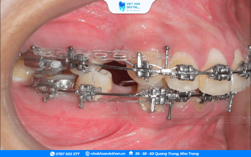 Giai đoạn đóng khoảng trong niềng răng mắc cài