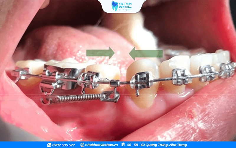 Phối hợp kéo răng cửa ra sau và kéo răng sau ra trước