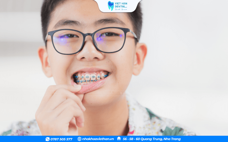 Niềng răng càng sớm càng tốt