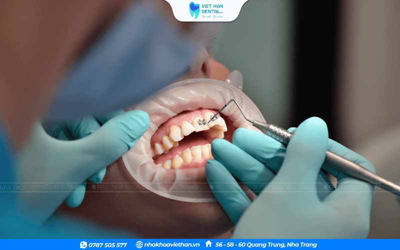 Nên chọn nha khoa uy tín để có kết quả niềng răng thành công