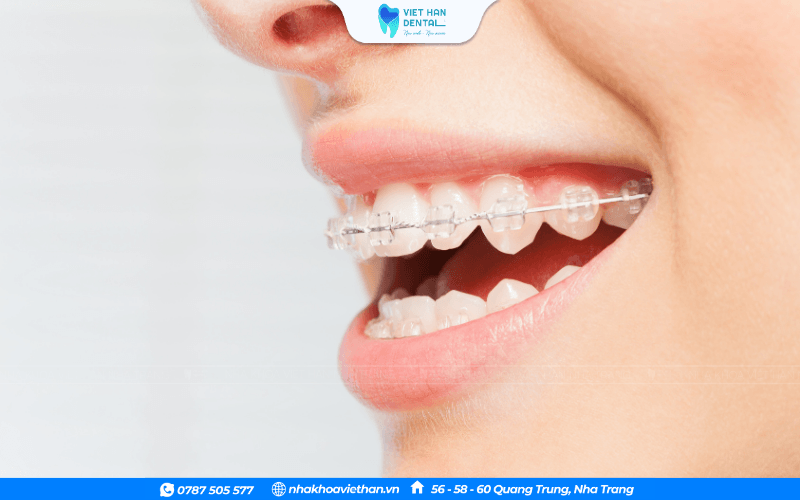 Niềng răng mắc cài sứ
