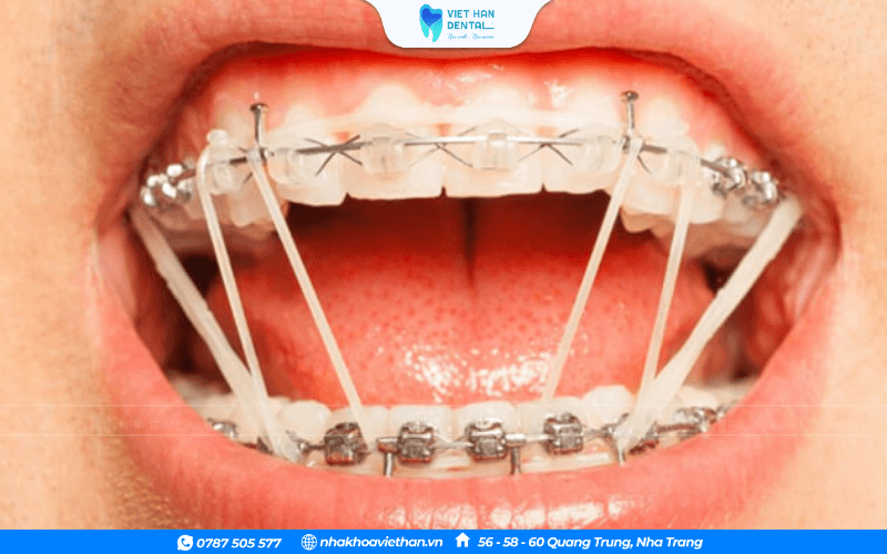 Sử dụng thun để đóng khoảng